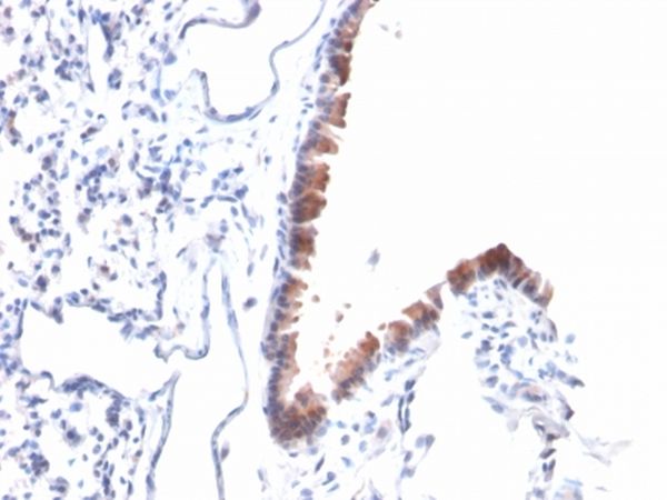 Immunohistochemistry (Formalin/PFA-fixed paraffin-embedded sections) - Anti-Mesothelin antibody [MSLN/2131] - BSA and Azide free (AB237817), expandable thumbnail