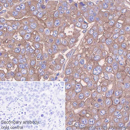 Immunohistochemistry (Formalin/PFA-fixed paraffin-embedded sections) - Anti-Mesothelin antibody [SP74] (AB93620), expandable thumbnail