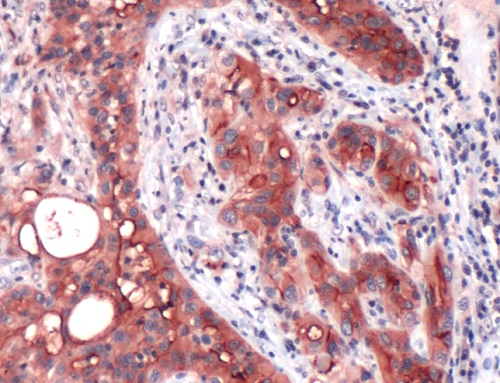 Immunohistochemistry (Formalin/PFA-fixed paraffin-embedded sections) - Anti-Mesothelin antibody [SP74] (AB93620), expandable thumbnail