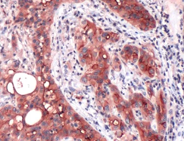 Immunohistochemistry (Formalin/PFA-fixed paraffin-embedded sections) - Anti-Mesothelin antibody [SP74] - BSA and Azide free (AB236217)