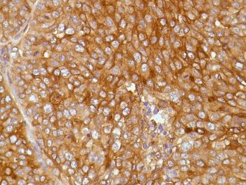 Immunohistochemistry (Formalin/PFA-fixed paraffin-embedded sections) - Anti-Mesothelin antibody [SP74] - C-terminal, prediluted (AB228144), expandable thumbnail