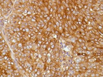 Immunohistochemistry (Formalin/PFA-fixed paraffin-embedded sections) - Anti-Mesothelin antibody [SP74] - C-terminal, prediluted (AB228144)
