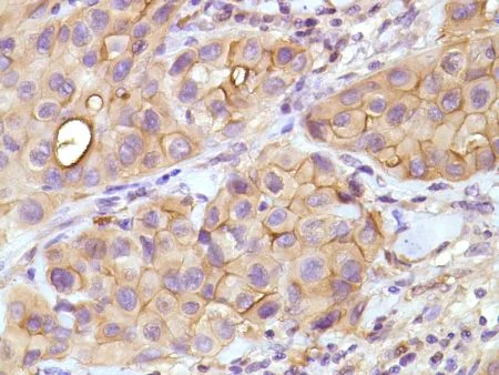 Immunohistochemistry (Formalin/PFA-fixed paraffin-embedded sections) - Anti-Mesothelin antibody [SP74] - C-terminal, prediluted (AB228144)