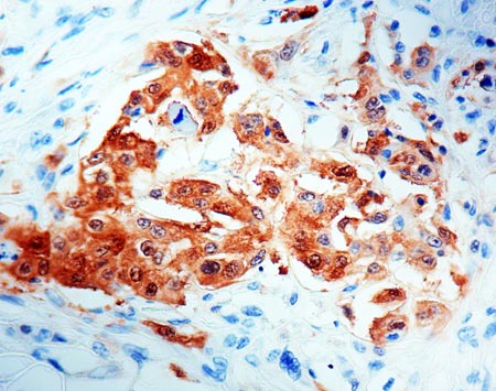 Immunohistochemistry (Formalin/PFA-fixed paraffin-embedded sections) - Anti-Mesothelioma antibody [HBME-1] (AB2383)