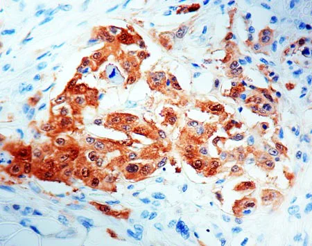 Immunohistochemistry (Formalin/PFA-fixed paraffin-embedded sections) - Anti-Mesothelioma antibody [HBME-1] (AB2383)