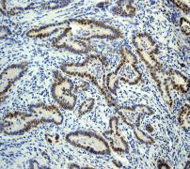 Immunohistochemistry (Formalin/PFA-fixed paraffin-embedded sections) - Mismatch Repair (MSH6, PMS2, MLH1, MSH2) Antibody Panel - Human (AB252190), expandable thumbnail