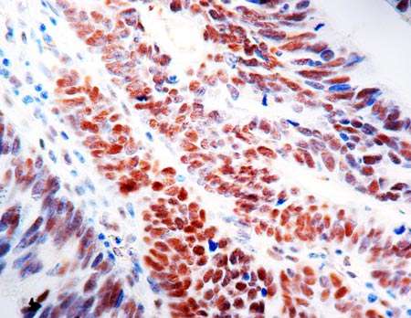 Immunohistochemistry (Formalin/PFA-fixed paraffin-embedded sections) - Anti-MLH1 antibody [G168-15] (AB14206), expandable thumbnail