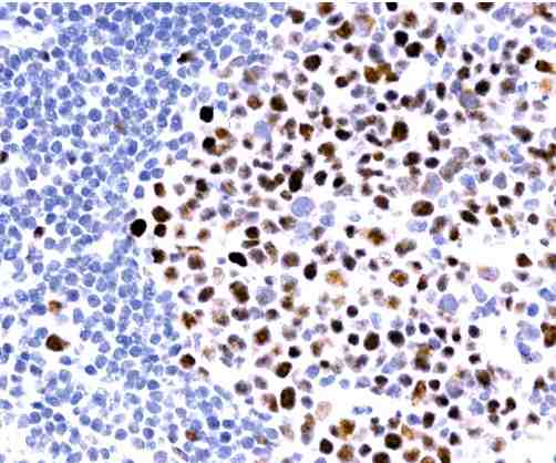 Immunohistochemistry (Formalin/PFA-fixed paraffin-embedded sections) - Anti-MLH1 antibody [G168-15] (AB14206), expandable thumbnail