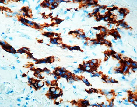 Immunohistochemistry (Formalin/PFA-fixed paraffin-embedded sections) - Anti-MUC1 antibody [E29] (AB6261)