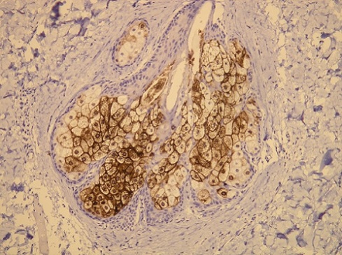 Immunohistochemistry (Formalin/PFA-fixed paraffin-embedded sections) - Anti-MUC1 antibody [G22-L] (AB136615)