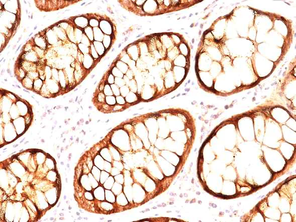 Immunohistochemistry (Formalin/PFA-fixed paraffin-embedded sections) - Anti-MUC1 antibody [GP14 + E29] (AB200543)