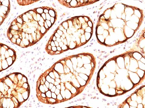Immunohistochemistry (Formalin/PFA-fixed paraffin-embedded sections) - Anti-MUC1 antibody [GP14 + E29] - BSA and Azide free (AB269802)