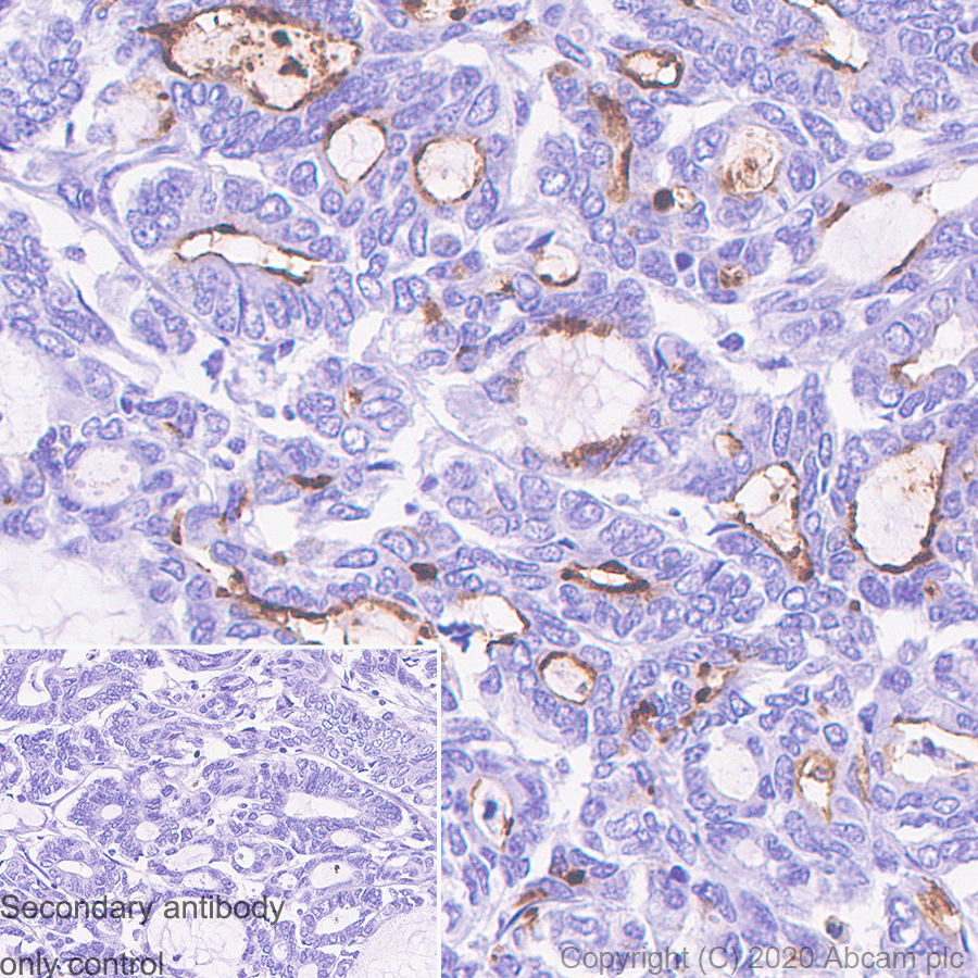 Immunohistochemistry (Formalin/PFA-fixed paraffin-embedded sections) - Anti-MUC1 antibody [HMFG1 (aka 1.10.F3)] - BSA and Azide free (AB230298)