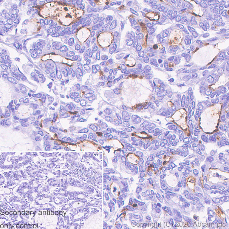Immunohistochemistry (Formalin/PFA-fixed paraffin-embedded sections) - Anti-MUC1 antibody [HMFG1 (aka 1.10.F3)] - BSA and Azide free (AB230298)