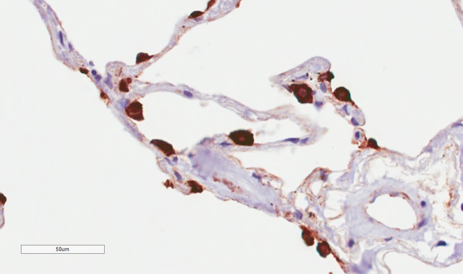 Immunohistochemistry (Formalin/PFA-fixed paraffin-embedded sections) - Anti-MUC1 antibody [HMFG2] (AB245693), expandable thumbnail