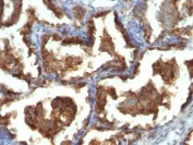 Immunohistochemistry (Formalin/PFA-fixed paraffin-embedded sections) - Anti-MUC1 antibody [MUC1/955] - BSA and Azide free (AB212621)