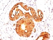 Immunohistochemistry (Formalin/PFA-fixed paraffin-embedded sections) - Anti-MUC1 antibody [MUC1/955] - BSA and Azide free (AB212621), expandable thumbnail