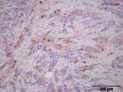 Immunohistochemistry (Formalin/PFA-fixed paraffin-embedded sections) - Anti-MUC1 antibody [SM3] (AB22711), expandable thumbnail