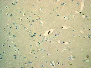Immunohistochemistry (Formalin/PFA-fixed paraffin-embedded sections) - Anti-MUC16 antibody [EPR1020(2)] - BSA and Azide free (AB230497)