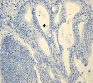 Immunohistochemistry (Formalin/PFA-fixed paraffin-embedded sections) - Anti-MUC16 antibody [EPR1020(2)] - BSA and Azide free (AB230497)