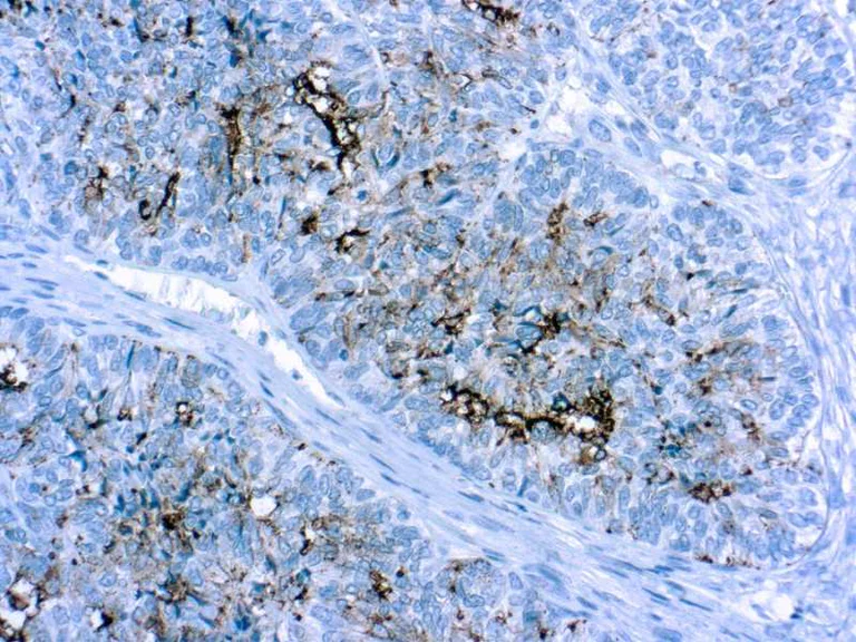 Immunohistochemistry (Formalin/PFA-fixed paraffin-embedded sections) - Anti-MUC16 antibody [OV185:1] (AB697)