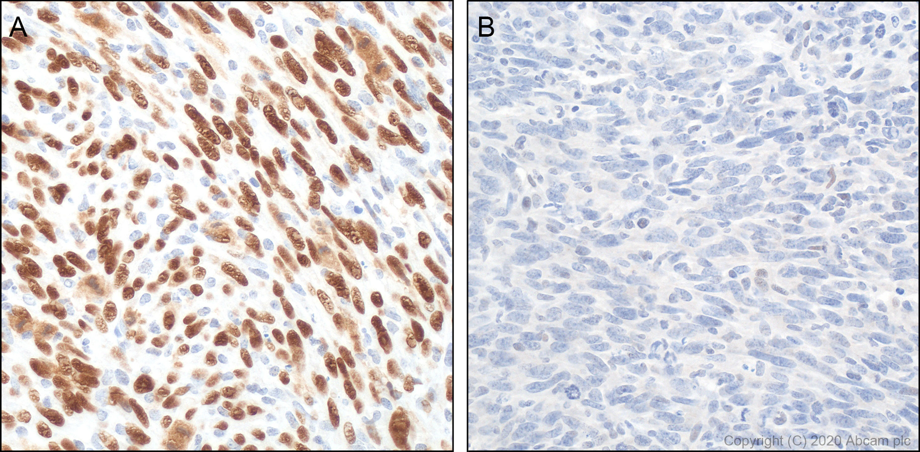 Immunohistochemistry (Formalin/PFA-fixed paraffin-embedded sections) - Anti-p53 antibody [POE316A] (AB241566), expandable thumbnail