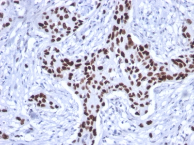 Immunohistochemistry (Formalin/PFA-fixed paraffin-embedded sections) - Anti-p53 antibody [rTP53/1739] - BSA and Azide free (AB237919), expandable thumbnail