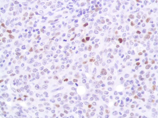 Immunohistochemistry (Formalin/PFA-fixed paraffin-embedded sections) - Anti-p53 antibody [SP161] (AB227655)