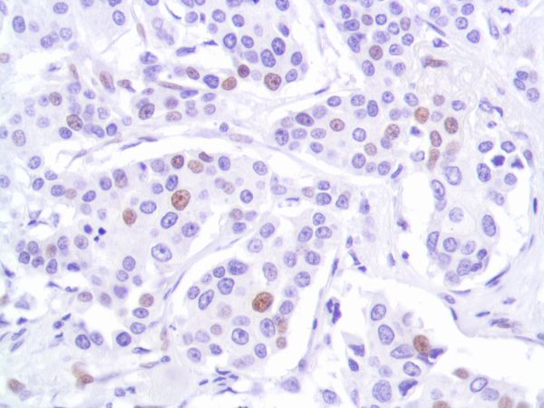 Immunohistochemistry (Formalin/PFA-fixed paraffin-embedded sections) - Anti-p53 antibody [SP161] - BSA and Azide free (ab245740), expandable thumbnail