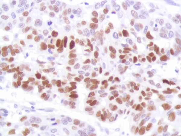 Immunohistochemistry (Formalin/PFA-fixed paraffin-embedded sections) - Anti-p53 antibody [SP161] - BSA and Azide free (ab245740), expandable thumbnail