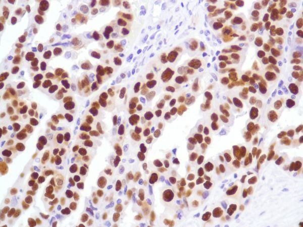 Immunohistochemistry (Formalin/PFA-fixed paraffin-embedded sections) - Anti-p53 antibody [SP5] - BSA and Azide free (AB242379), expandable thumbnail