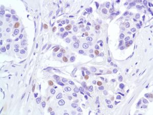 Immunohistochemistry (Formalin/PFA-fixed paraffin-embedded sections) - Anti-p53 antibody [SP5], prediluted (AB27598), expandable thumbnail