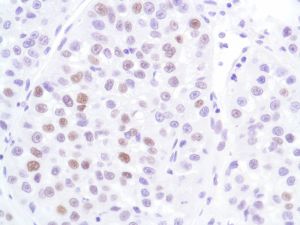Immunohistochemistry (Formalin/PFA-fixed paraffin-embedded sections) - Anti-p53 antibody [SP5], prediluted (AB27598), expandable thumbnail