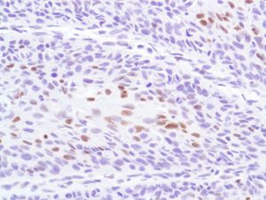 Immunohistochemistry (Formalin/PFA-fixed paraffin-embedded sections) - Anti-p53 antibody [SP5], prediluted (AB27598), expandable thumbnail