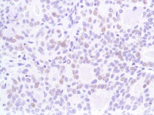 Immunohistochemistry (Formalin/PFA-fixed paraffin-embedded sections) - Anti-p53 antibody [SP5], prediluted (AB27598), expandable thumbnail