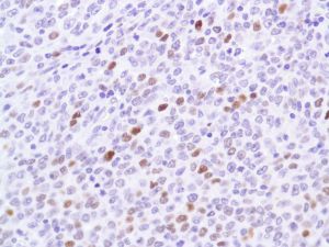 Immunohistochemistry (Formalin/PFA-fixed paraffin-embedded sections) - Anti-p53 antibody [SP5], prediluted (AB27598), expandable thumbnail