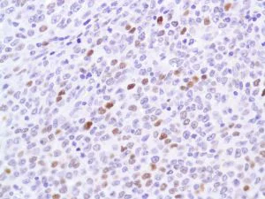 Immunohistochemistry (Formalin/PFA-fixed paraffin-embedded sections) - Anti-p53 antibody [SP5], prediluted (AB27598)