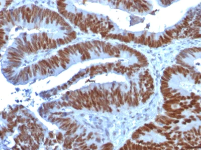 Immunohistochemistry (Formalin/PFA-fixed paraffin-embedded sections) - Anti-p53 antibody [TP53/1739] - BSA and Azide free (AB237920)