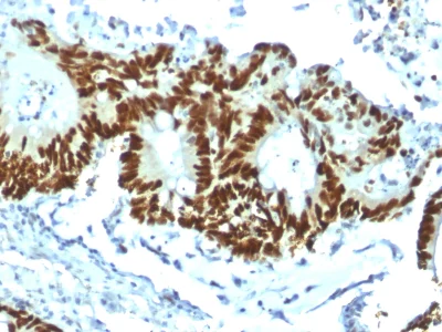 Immunohistochemistry (Formalin/PFA-fixed paraffin-embedded sections) - Anti-p53 antibody [TP53/1799R] - BSA and Azide free (AB237921)