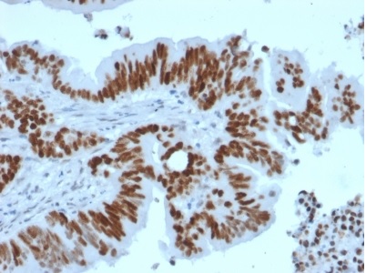 Immunohistochemistry (Formalin/PFA-fixed paraffin-embedded sections) - Anti-p53 antibody [TP53/2092R] - BSA and Azide free (AB237922), expandable thumbnail