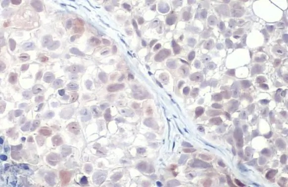 Immunohistochemistry (Formalin/PFA-fixed paraffin-embedded sections) - Anti-p53 R175H Mutant antibody [HL1129] (AB308342), expandable thumbnail