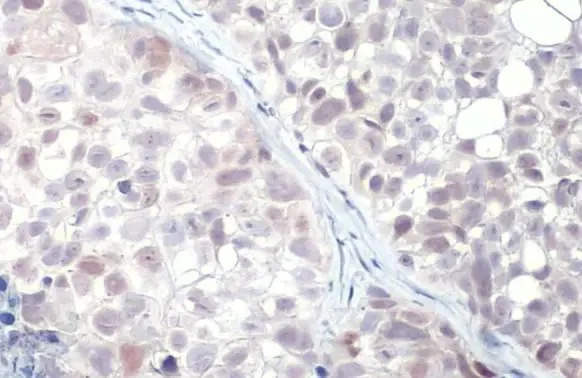 Immunohistochemistry (Formalin/PFA-fixed paraffin-embedded sections) - Anti-p53 R175H Mutant antibody [HL1129] (AB308342)