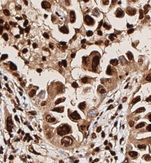 Immunohistochemistry (Formalin/PFA-fixed paraffin-embedded sections) - Anti-pan-AKT (phospho T308) antibody (AB8933), expandable thumbnail