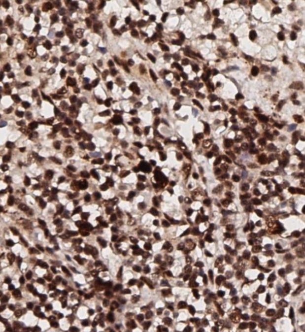 Immunohistochemistry (Formalin/PFA-fixed paraffin-embedded sections) - Anti-pan-AKT (phospho T308) antibody (ab8933), expandable thumbnail