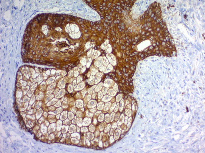 Immunohistochemistry (Formalin/PFA-fixed paraffin-embedded sections) - Anti-pan Cytokeratin antibody [PAN-CK (Cocktail)] (AB215838), expandable thumbnail