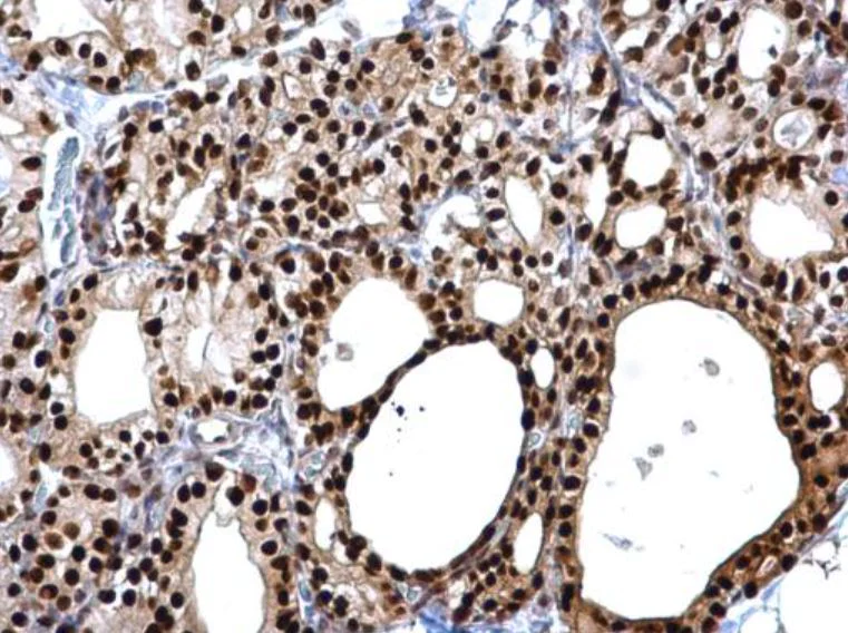 Immunohistochemistry (Formalin/PFA-fixed paraffin-embedded sections) - Anti-PAX8 antibody (AB97477)