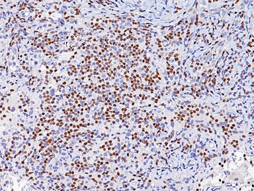 Immunohistochemistry (Formalin/PFA-fixed paraffin-embedded sections) - Anti-PAX8 antibody [BC12] (AB124445), expandable thumbnail