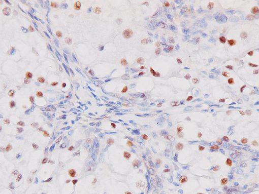 Immunohistochemistry (Formalin/PFA-fixed paraffin-embedded sections) - Anti-PAX8 antibody [BC12] (AB124445), expandable thumbnail