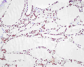 Immunohistochemistry (Formalin/PFA-fixed paraffin-embedded sections) - Anti-PAX8 antibody [EPR13510] (AB181054), expandable thumbnail
