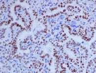 Immunohistochemistry (Formalin/PFA-fixed paraffin-embedded sections) - Anti-PAX8 antibody [EPR13511] - C-terminal (AB189249), expandable thumbnail